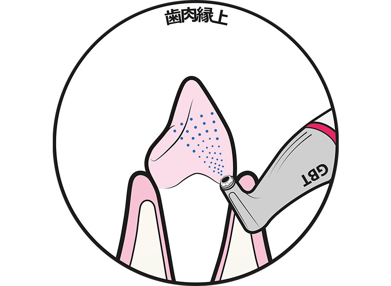 STEP4　歯肉縁上・縁下のエアフロー