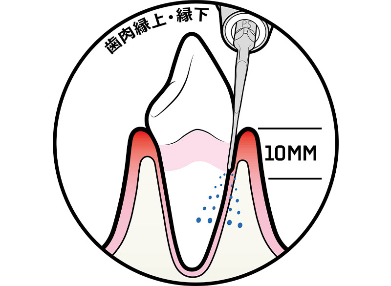 STEP6　残った歯石の除去