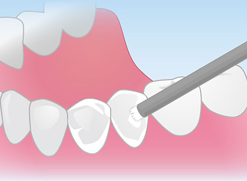 STEP7　最終確認とフッ素塗布