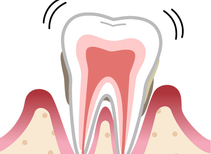 歯周病