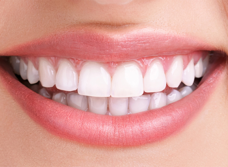 ホワイトニング