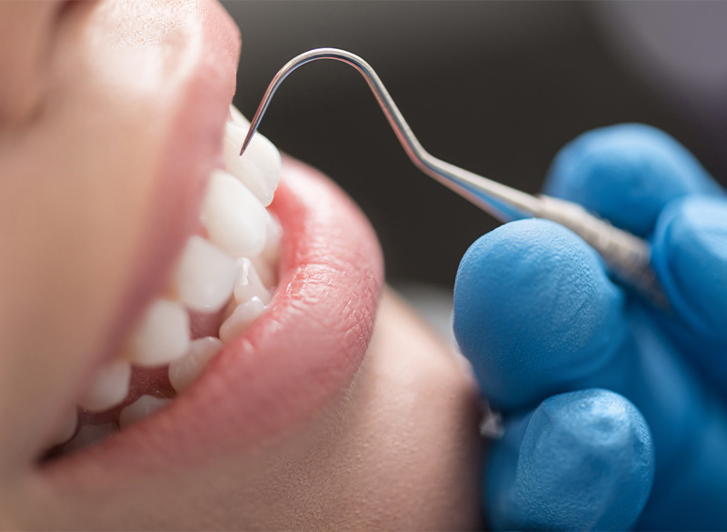 予防・クリーニング